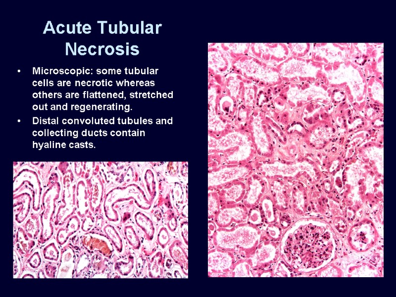 Acute Tubular Necrosis Microscopic: some tubular cells are necrotic whereas others are flattened, stretched